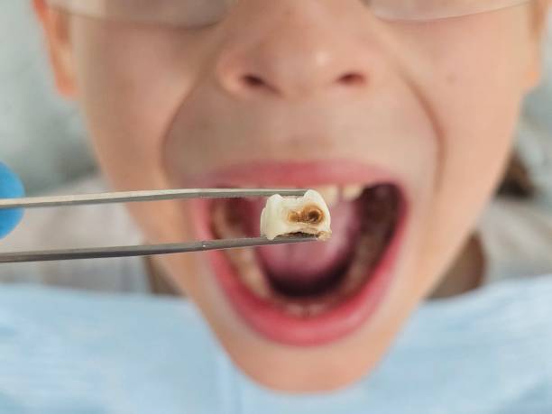Best Cracked Tooth Emergency Dentist  in Telluride, CO