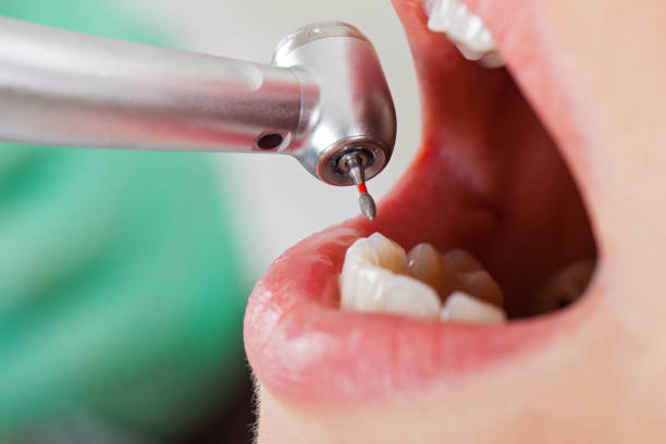 Best Root Canal Emergency Dentist  in Telluride, CO